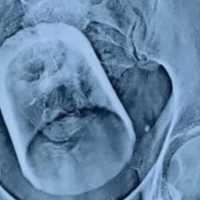 Heboh Gelas Kaca Ditemukan di Perut Warga Jember, Ini Penjelasan Medisnya