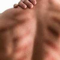 Manfaat Kerokan Bagi Kesehatan dan Risiko yang Bisa Ditimbulkan