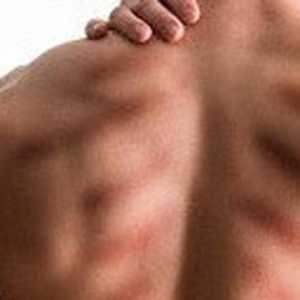 Manfaat Kerokan Bagi Kesehatan dan Risiko yang Bisa Ditimbulkan