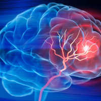 Reza Gunawan Meninggal Gegara Stroke, Begini Gejala dan Penyebabnya