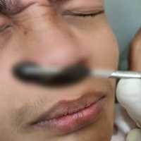 Mengerikan, Lintah Sebesar Jempol Ini Hidup di Hidung Pria Asal Bogor
