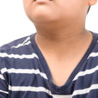 Kulit Leher Menghitam Bukan Melulu Gegara Daki, Waspada Idap Penyakit Berbahaya Ini