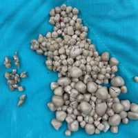 Dokter Angkat 300 Batu Ginjal dari Tubuh Wanita yang Tak Suka Minum Air Putih