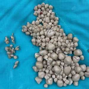 Dokter Angkat 300 Batu Ginjal dari Tubuh Wanita yang Tak Suka Minum Air Putih